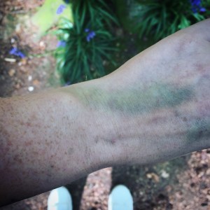 Bruises and bluebells