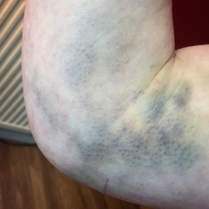 Bruises